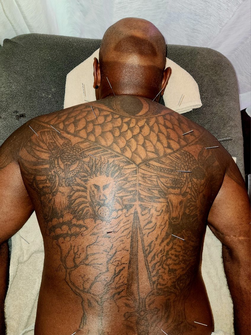 Acupuncture treatment