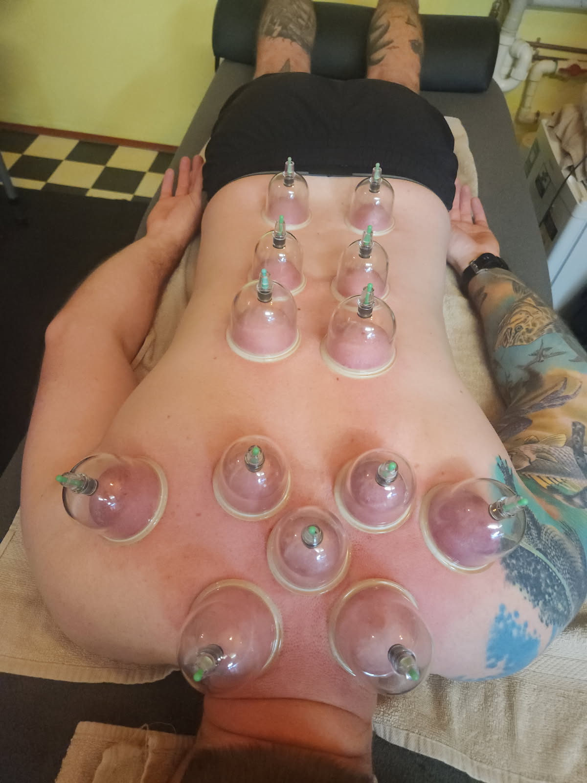 Cupping therapy treatment